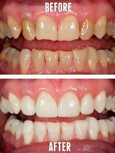 StopSensitivity's tweet photo. Wouldn’t you be excited about these results as a patient? #StopSensitivity #Dentistry #Hygiene http://t.co/bXOcrEgMIK