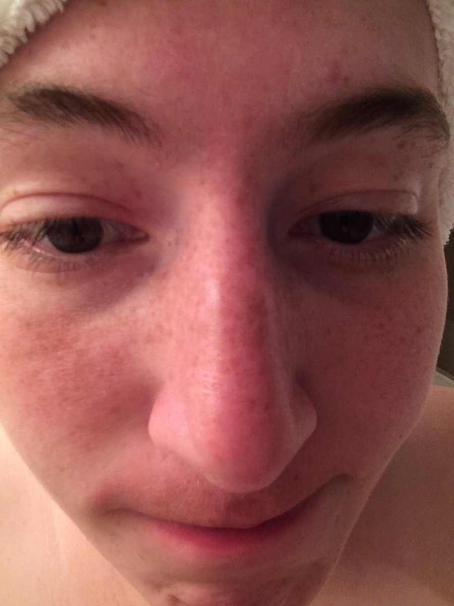 _Metonymy_'s tweet photo. It's been TWO DAYS face! Two. Days. #frecklesquad http://t.co/EKQUQDyWRI