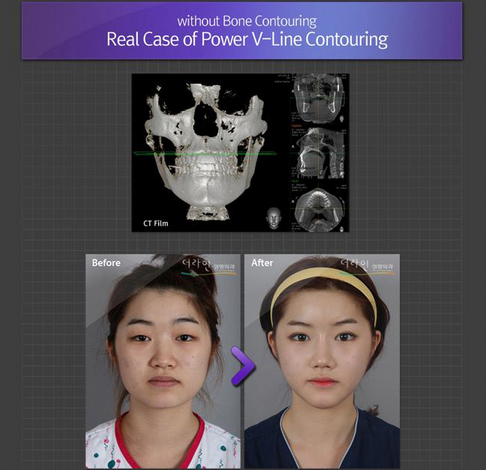 veronikanikitn's tweet photo. https://t.co/vjOzDawCRw
Мощность V Контурная
#vlinecontouring #facialcontouring #chinsurgery http://t.co/VhyZ5kHGz5