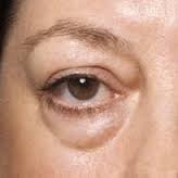 TheProLogic1's tweet photo. #eyebags 
Fat loss beneath the eye or shadowing due to #skin laxity
@Gidi_Traffic @TrafficChiefNG @NigeriaNewsdesk http://t.co/nvGg4FgpQO