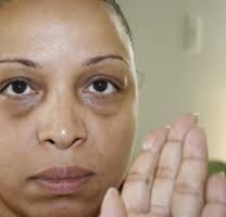 TheProLogic1's tweet photo. #eyebags 
Fat loss beneath the eye or shadowing due to #skin laxity
@Gidi_Traffic @TrafficChiefNG @NigeriaNewsdesk http://t.co/nvGg4FgpQO