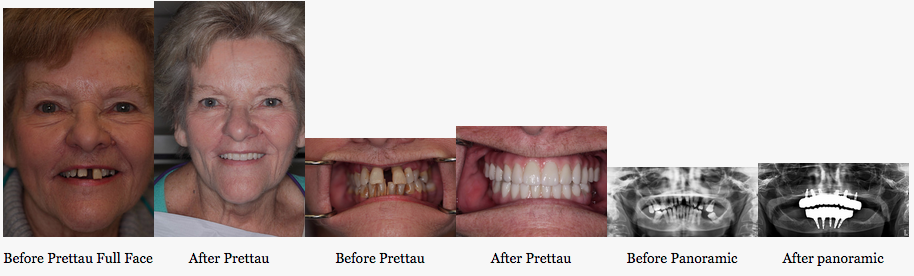 TeethTomorrow's tweet photo. Another #TeethTomorrow transformation inspiring us to keep changing lives. You're success story is next! #oralhealth http://t.co/BeVnqYrwCY