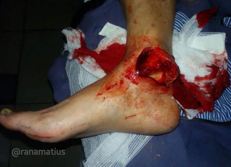 Golpe En La Tibia Con Bulto FRACTURA EXPUESTA DE TIBIA Y PERONE PDF