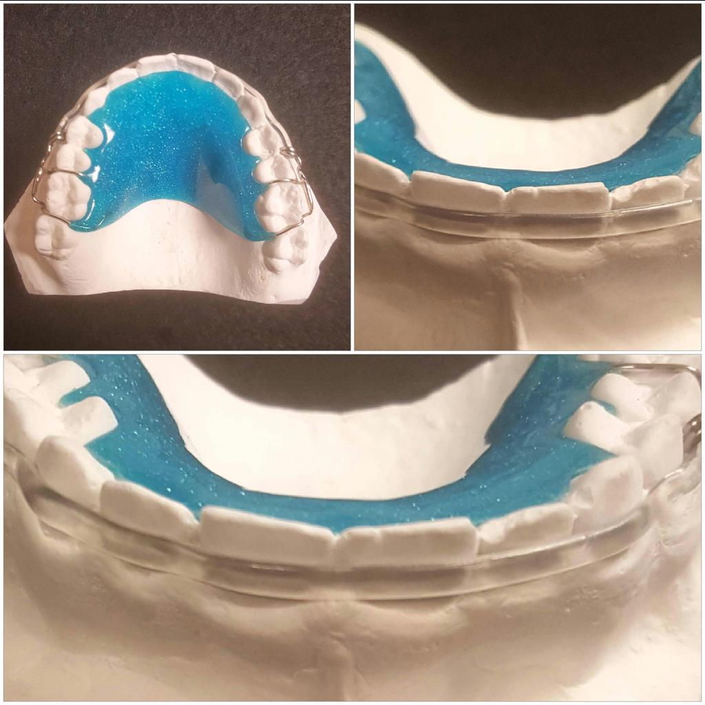 ReserveOrthoLab's tweet photo. It's been awhile since the last #coolestapplianceoftheday so here it is. The new ClearBow labial bow in action. http://t.co/Uqx0aTtZ93