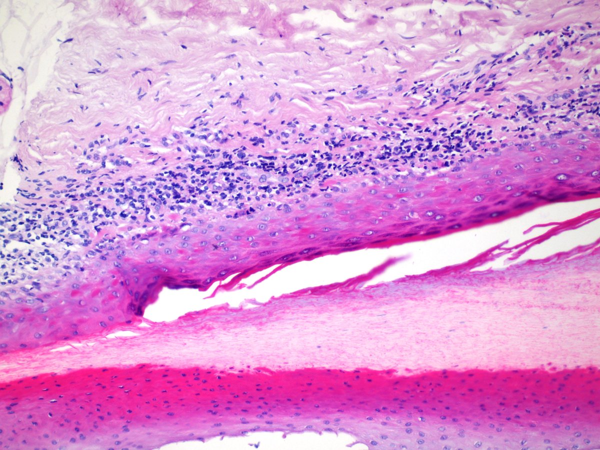 DOC_MEK's tweet photo. F, 60yo, onychorrhexis 20 nails. Lichen Planus. #dermpath http://t.co/BvKOIWElfX