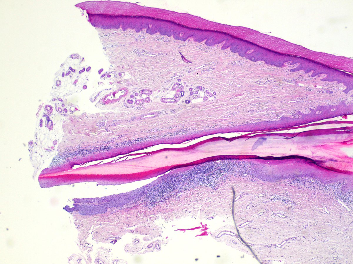 DOC_MEK's tweet photo. F, 60yo, onychorrhexis 20 nails. Lichen Planus. #dermpath http://t.co/BvKOIWElfX