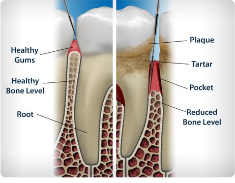 PdxDentistry's tweet photo. Periodontal disease affects 50% of Americans over the age of 30 &amp; 70% over the age of 75. #oralsystemicconnection http://t.co/EJ6nyRMMJ0