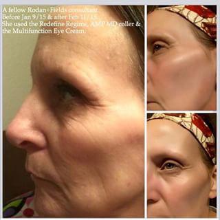 Klhiggins1's tweet photo. Here are a couple results from our amp md!!! Featured in #alluremagazine #nomorewrinkles http://t.co/j1Kdoe4tbR