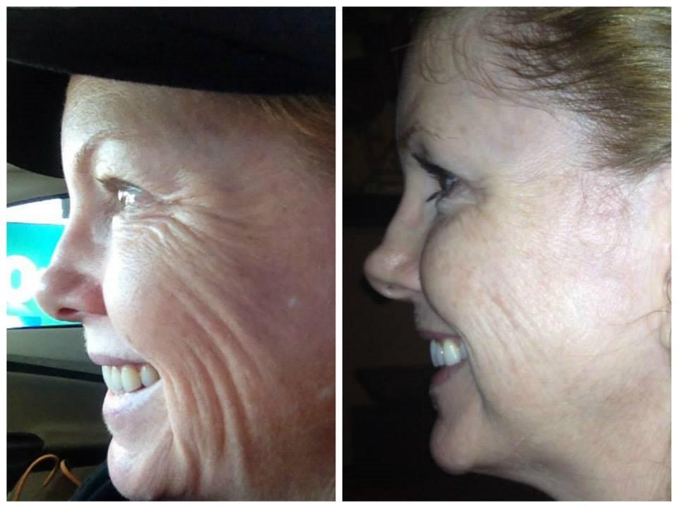 Klhiggins1's tweet photo. Here are a couple results from our amp md!!! Featured in #alluremagazine #nomorewrinkles http://t.co/j1Kdoe4tbR