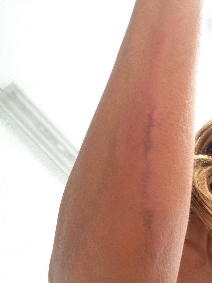limfatherapy's tweet photo. Solo un trattamento di Limfa® Therapy IMMEDIATAMENTE DOPO IL TRAUMA ... no edema, no dolore! http://t.co/7epo9FbBIB