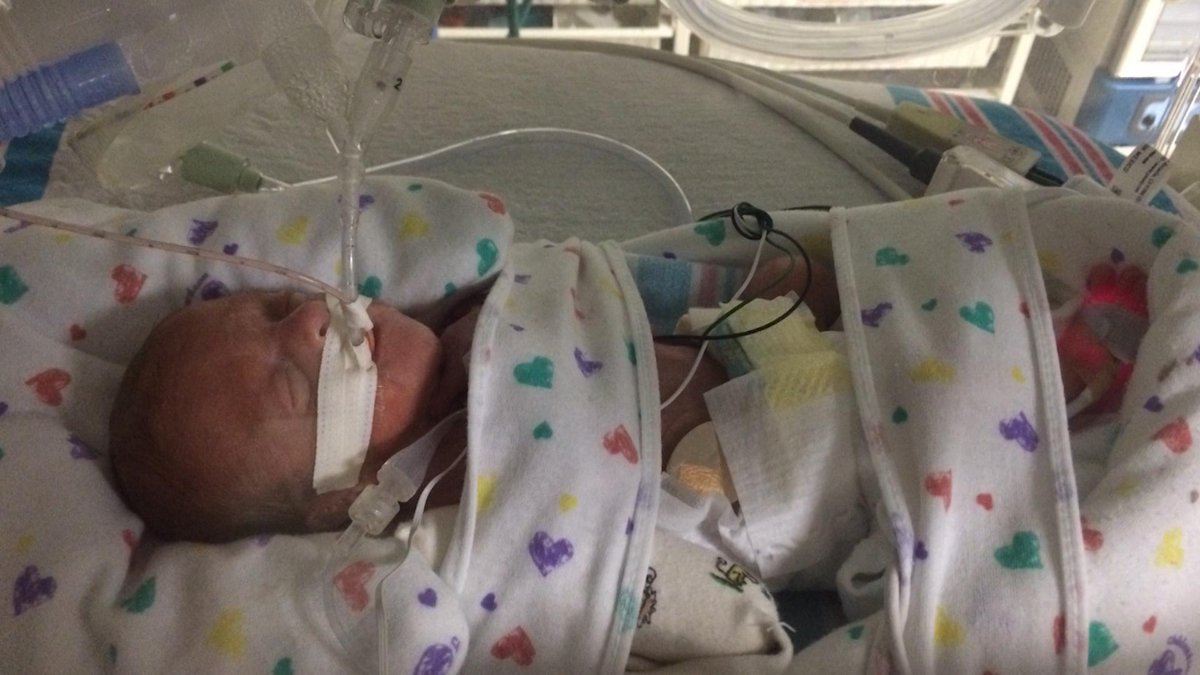CruiseLeaks_'s tweet photo. One pound #premature #baby survives birth aboard #cruise #ship
WOW!!! http://t.co/OWDC0Z1OvS
http://t.co/eUFsh45p8N http://t.co/cVxTLax4on