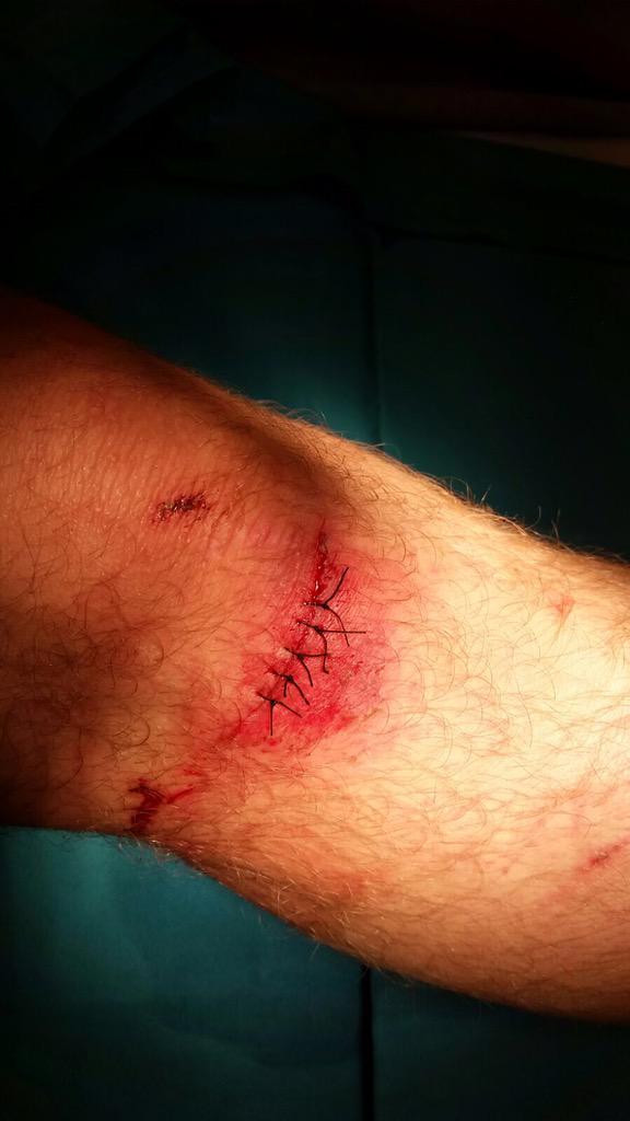 am_bikeskool's tweet photo. Ouch, first big casualty of the week 👷🚑💉 http://t.co/gN6uEPAseW