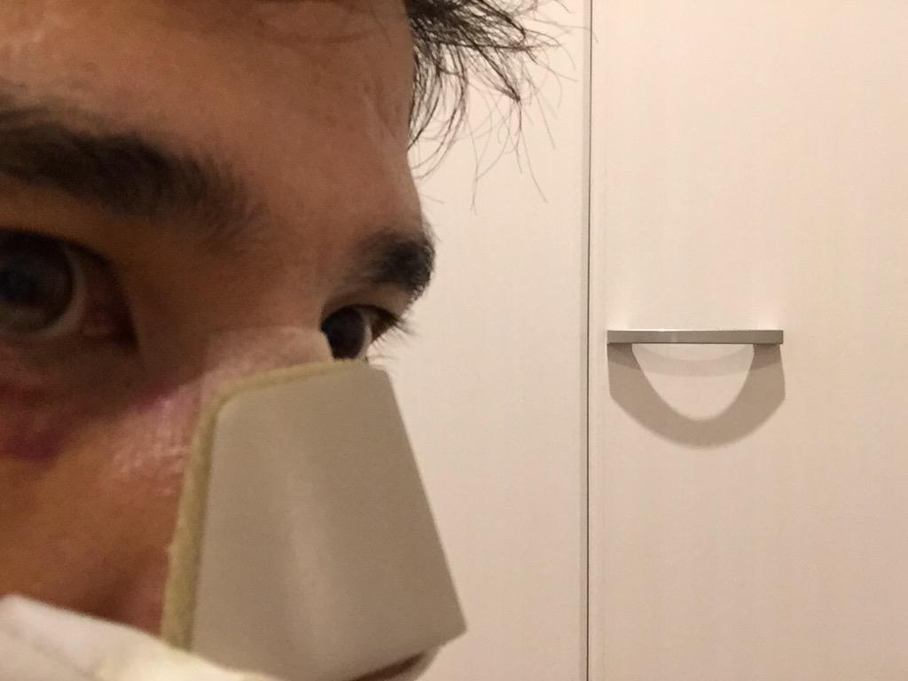 青木達哉 Tatsuya Aoki 鼻骨骨折で鼻固定中 どんな部位でも骨折というのは生活に支障を出しますね 鼻 の内側 両サイド にガーゼを詰めまくって圧迫している為 １週間口呼吸です 鼻骨骨折の治療をなめてました Http T Co 2issm96kb4 Twitter