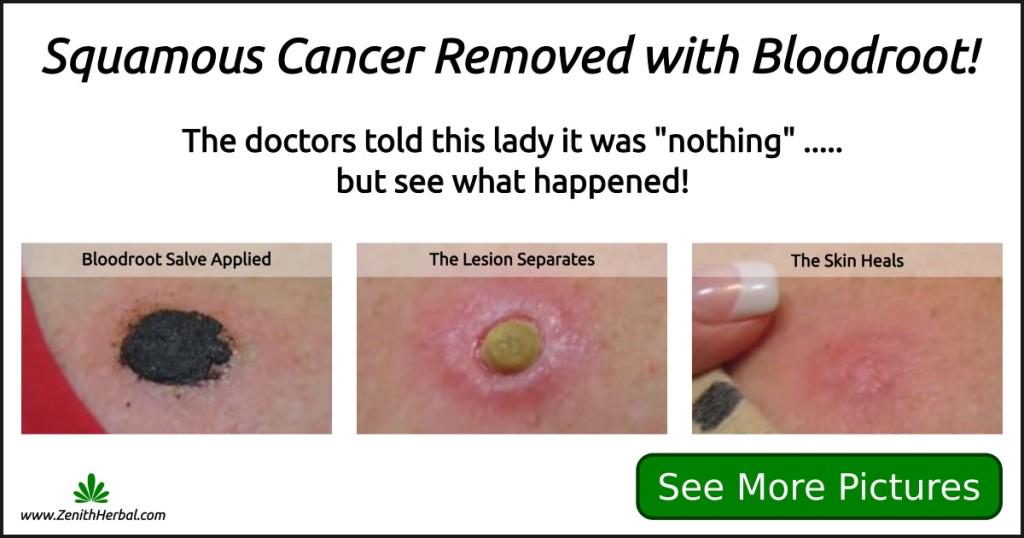 RuthEllenDee's tweet photo. See #Squamous Cancer Removed - http://t.co/i0fNaeZ4PU - #Testimonial http://t.co/RmFmlfvLvt