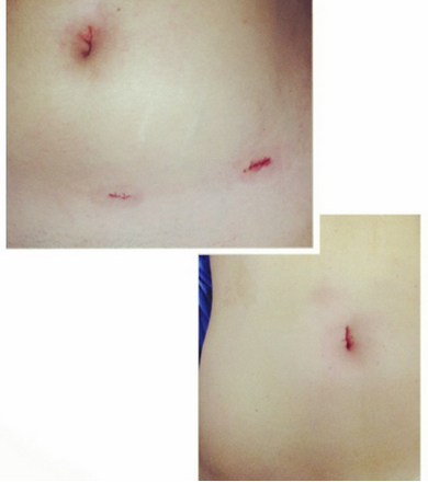 sinhuella's tweet photo. Laparoscopia tradicional vs #CirugíaSinHuella. Pacientes en postoperatorio inmediato de cirugía por APENDICITIS AGUDA http://t.co/bfWuxmYeYh