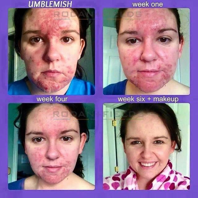 Klhiggins1's tweet photo. We have the #1 acne treatment in America!! Do you know someone I can help reclaim their skin!?? #clearskin http://t.co/sfNULHvYqP