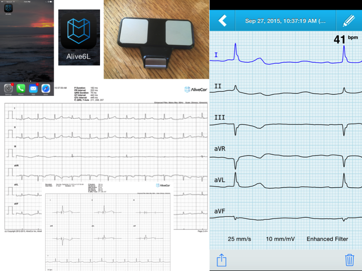 EricTopol's tweet photo. What about the "advanced" ECG machine w/ 281 parts, 10 wires vs the smartphone-ECG w/ 1 part? ?name for the latter http://t.co/Z2e97P61Za