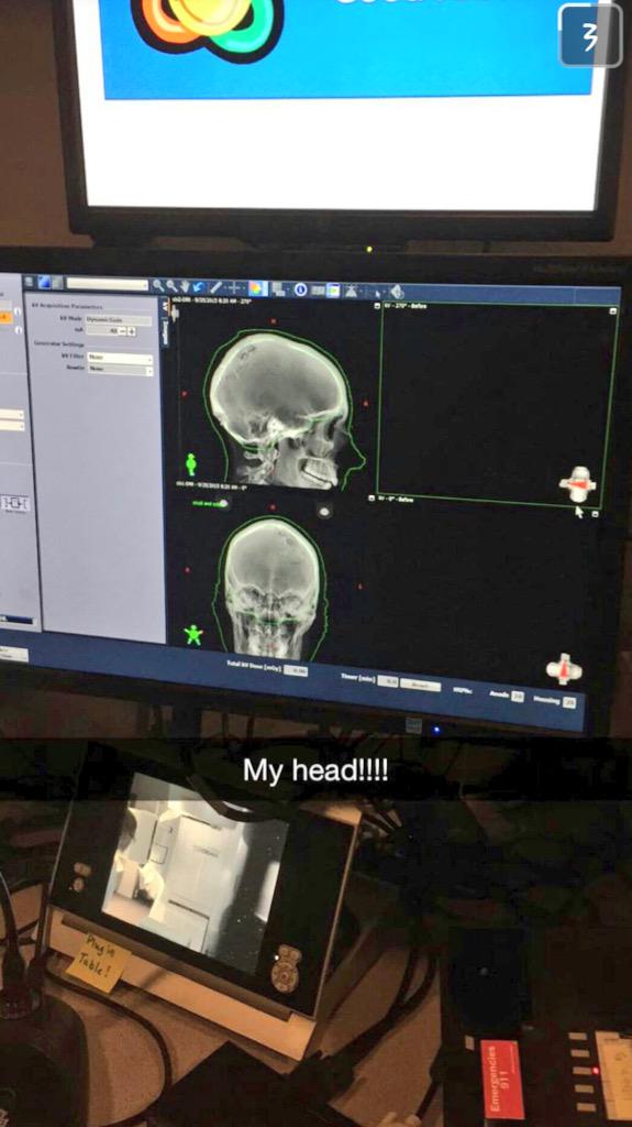 GrantJunghans's tweet photo. My head..... Looks kind of empty!!! Friday is the last day of treatment then headed back home after 2 weeks!!! #bdst http://t.co/mqipZam0Zt