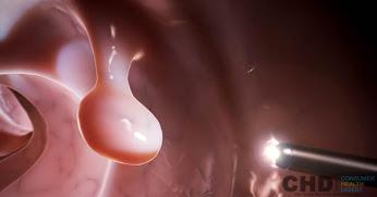 Colopril's tweet image. #ColonPolyps: Growth On The Lining of The Colon consumerhealthdigest.com/colon-health-c… @colonpolyps @Cleanse_Colon