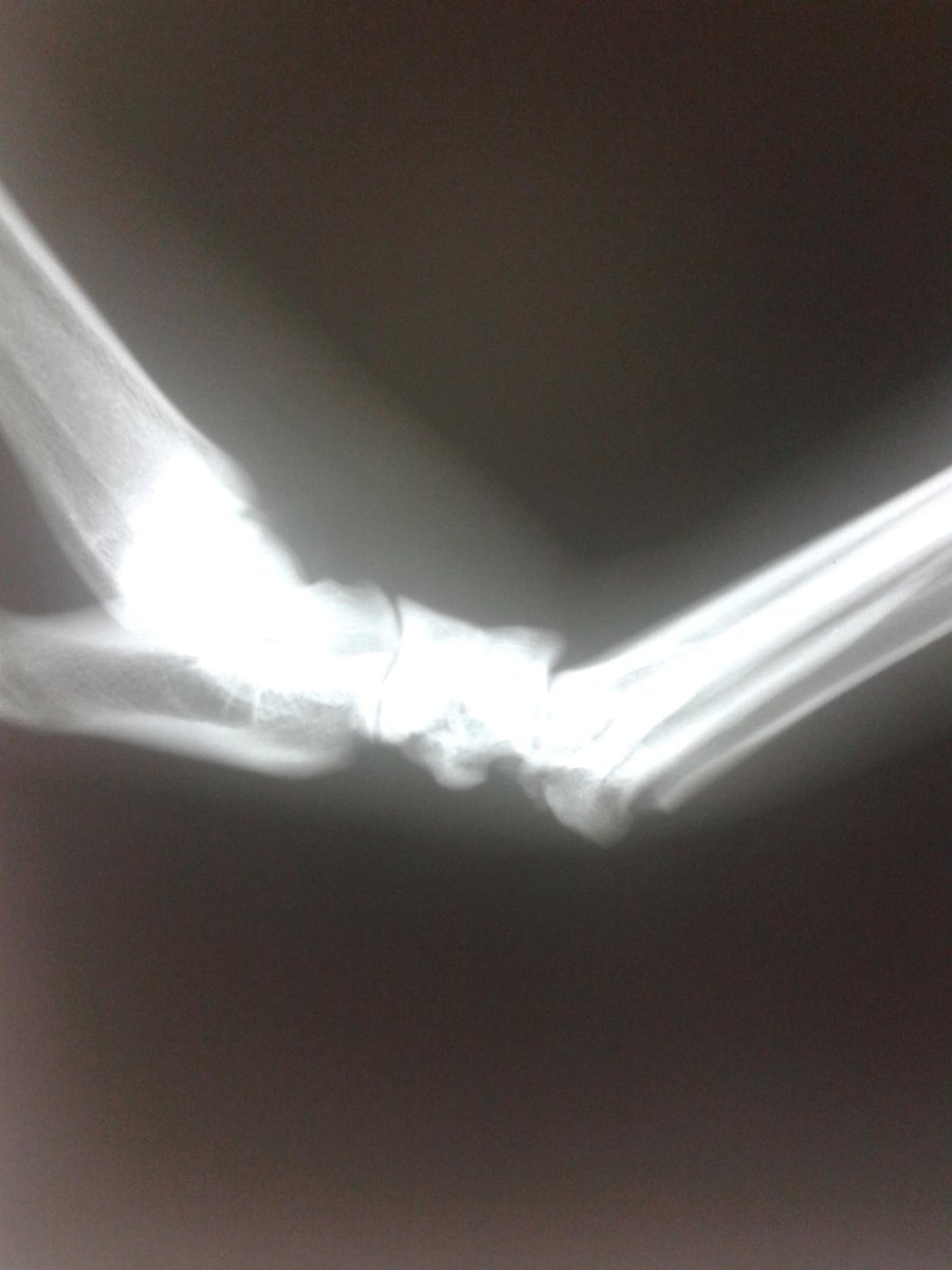 Dr_DannyRocks's tweet photo. luxo fractura tarso metatarsiana MPI http://t.co/Ykgz01IMNc