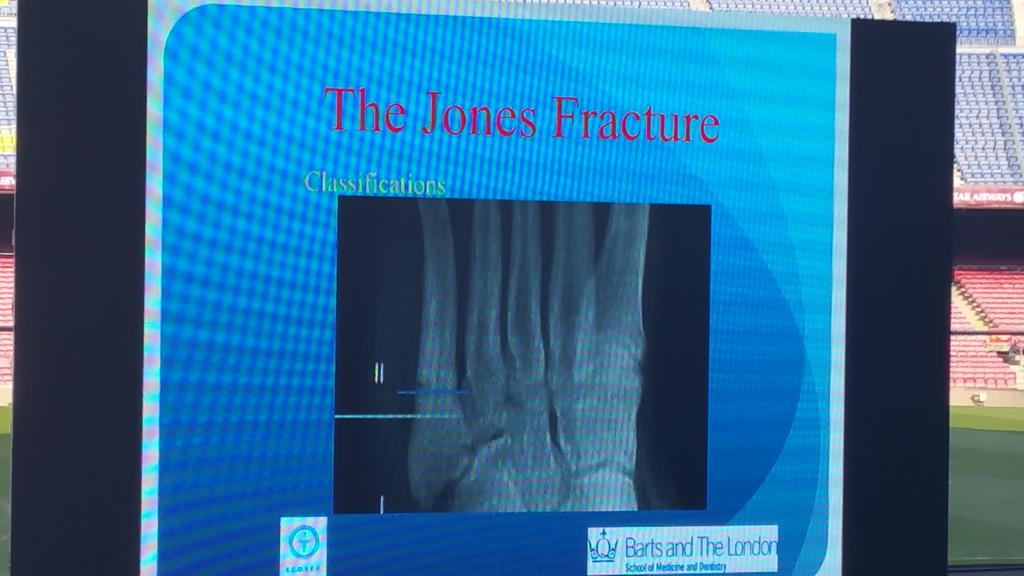 carlespedret's tweet image. The REAL Jones fracture. #MTNECOSEP