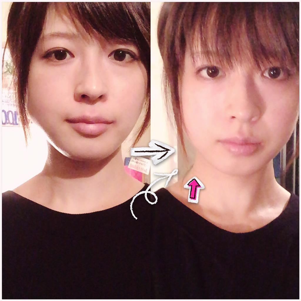 森崎まみ Twitterissa エラが気になりすぎてコルギのお試し行ってきた 左エラがなくなったけど老けた気がするw Http T Co Myrp21y5s8