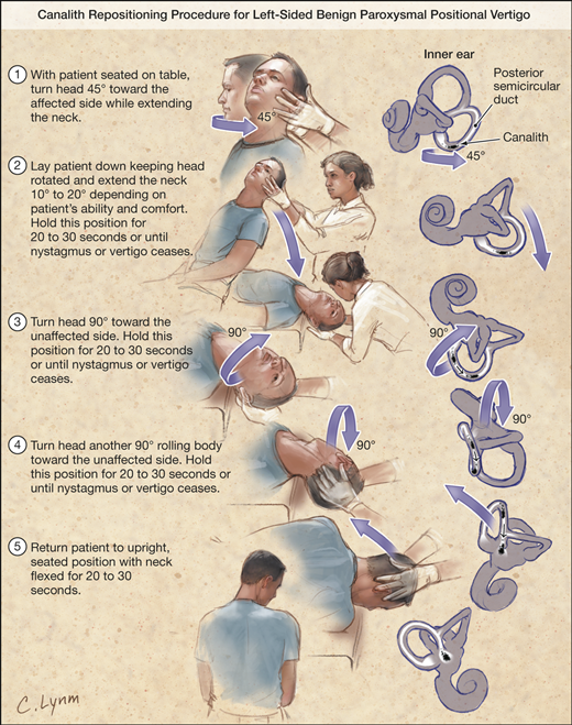 benign paroxysmal positional vertigo epley maneuver