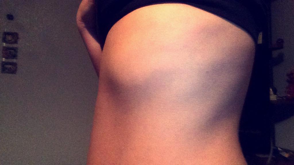 CassWessels's tweet photo. Don't worry coach my ribs are fine....๐
#iknow #gotoadoctor http://t.co/T0eJ5RuA2L