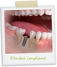 Cedarlea_Dental's tweet photo. We are excited to announce that we now offer Straumann Implants. http://t.co/jRgaNHarGk