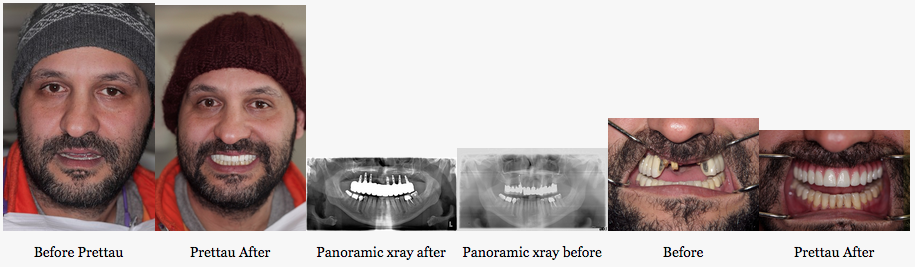 TeethTomorrow's tweet photo. #TransformationTuesday: successful case study = another reason to smile. This patient sure is! #dentalimplants #teeth http://t.co/yty8efq3G5