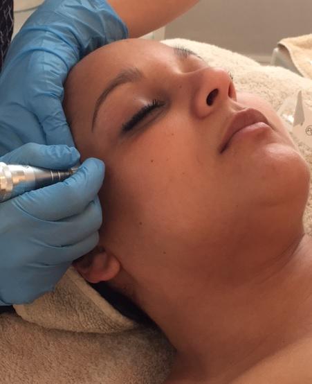 biorechercheuk's tweet image. Our #micropuncture treatment uses an incredibly precise needle application technique for targeted, visible results.