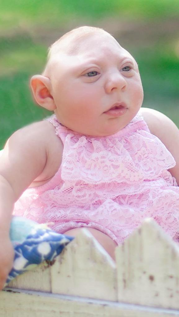 lorrieee_22's tweet photo. So thankful for this little miracle! #microcephalyawarenessday http://t.co/euKm9KHsAr