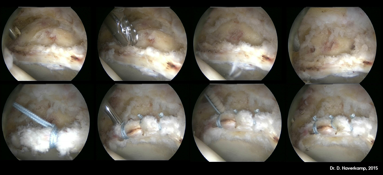 voorbeeld van heuparthroscopie met pincer resectie met labrum refixatie