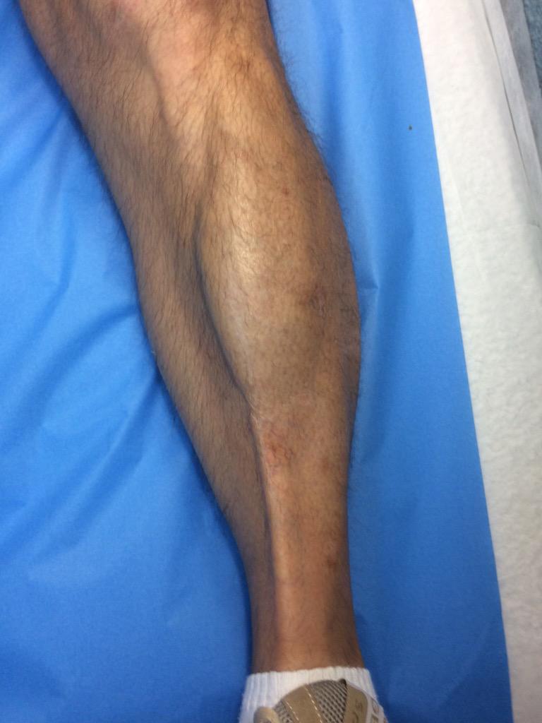 drlopezmartinez's tweet photo. Hipertrofia de músculo tibial anterior en marchador. http://t.co/LFbLI2Oj0S