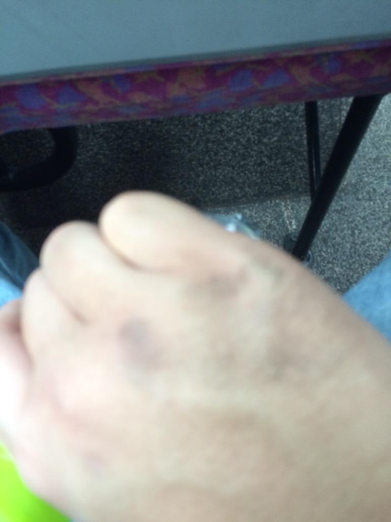 爪の傷や黒い粉 メリットなどありません トゥギャル F Togetter