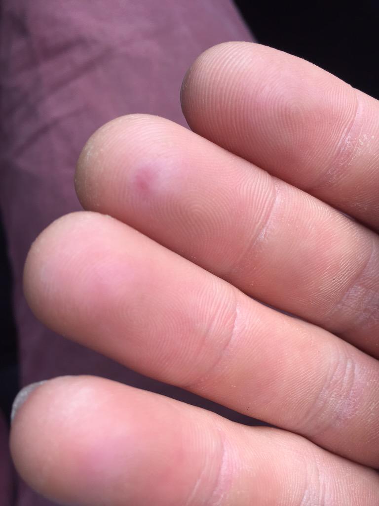 Matt_Catchpole's tweet photo. You know you're back to pushing yourself in climbing when you start getting the pink fingertips again! #AlmostFixed! http://t.co/q3cvIlM1LB