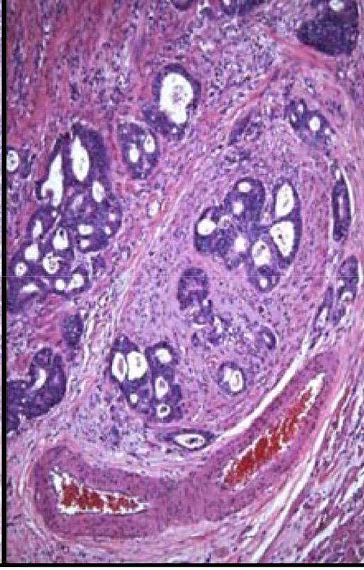 RMeunierMD's tweet image. Look for orphan artery sign to look for venous invasion in colorectal carcinoma #CAP15twiteratti