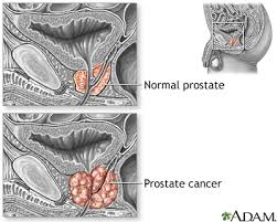 TheProLogic1's tweet photo. Symptom of #prostatecancer 
Pain when passing #urine 
@Gidi_Traffic @TrafficChiefNG @NigeriaNewsdesk @YNaija http://t.co/iC8cF0Ocq7