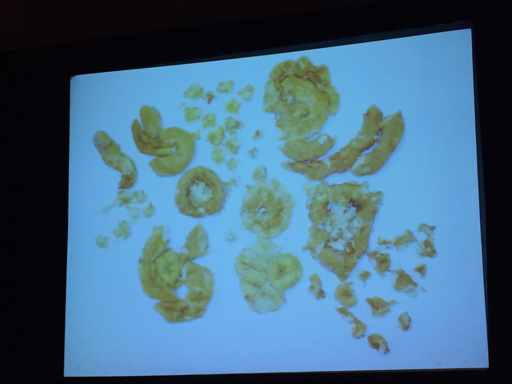 michhebert01's tweet image. Dr Epstein: Gleason grading with Krispy Kreme donuts. Grade 5 #CAP15 #pathologists