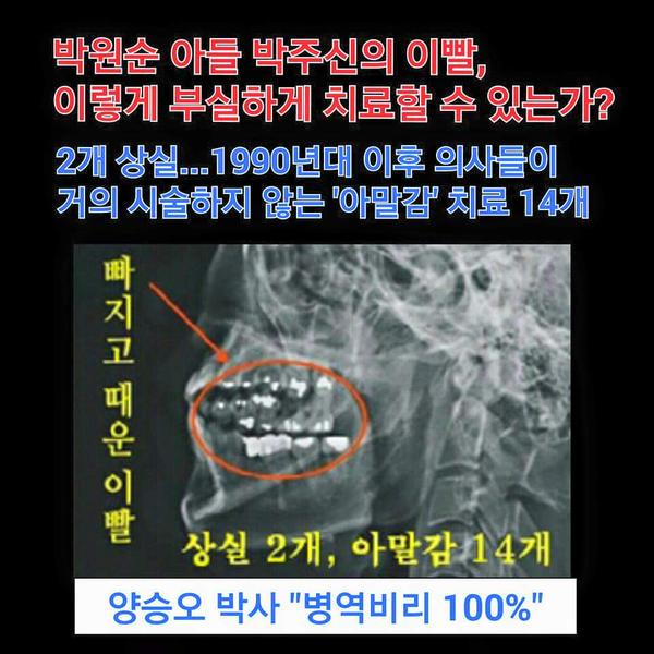 박주신  척추 MRI와 이빨 X-ray를 다른 환자  것과 바꿔지기해  병역을 기피,  영상의학 권위자 양승오  박사의 주장. 싸구려 아말감 14 개, 빠진 이빨 3 개 방치. 진실 위해 아들 불러 재검하라!