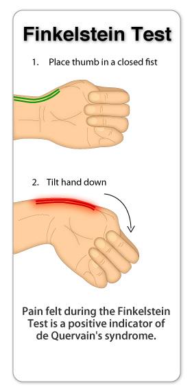 De Quervain szindróma, De Quervain tendonitis kezelése - Súlypont Ízületklinika