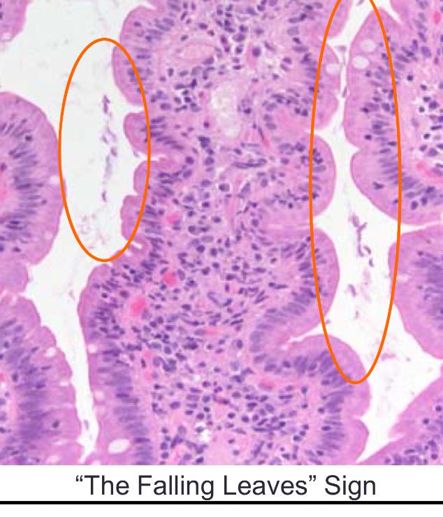 RMeunierMD's tweet image. Falling leaf sign: Giardia! #CAP15twiteratti