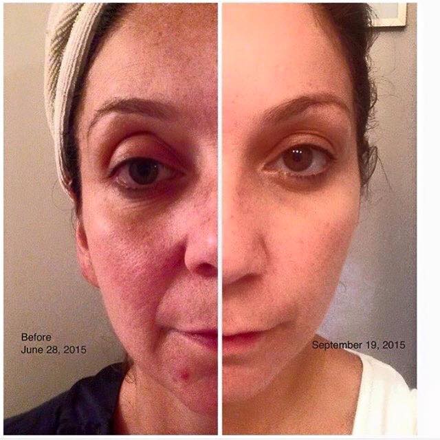 Kells_RandF's tweet image. Wash your face with drugstore products vs. CHANGE your skin with R+F multi-med regimens! #RandFsimplyworks