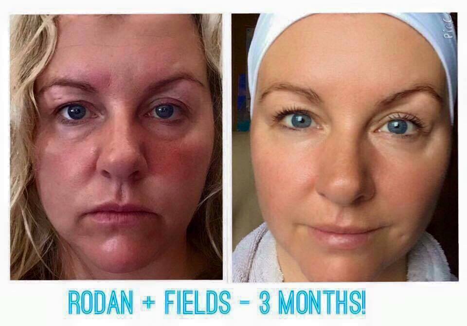 Kells_RandF's tweet image. 3 MONTHS: Reverse in the AM, Redefine with Amp MD Roller in the PM. Macro E 1x/week. 
Real photos, real results!