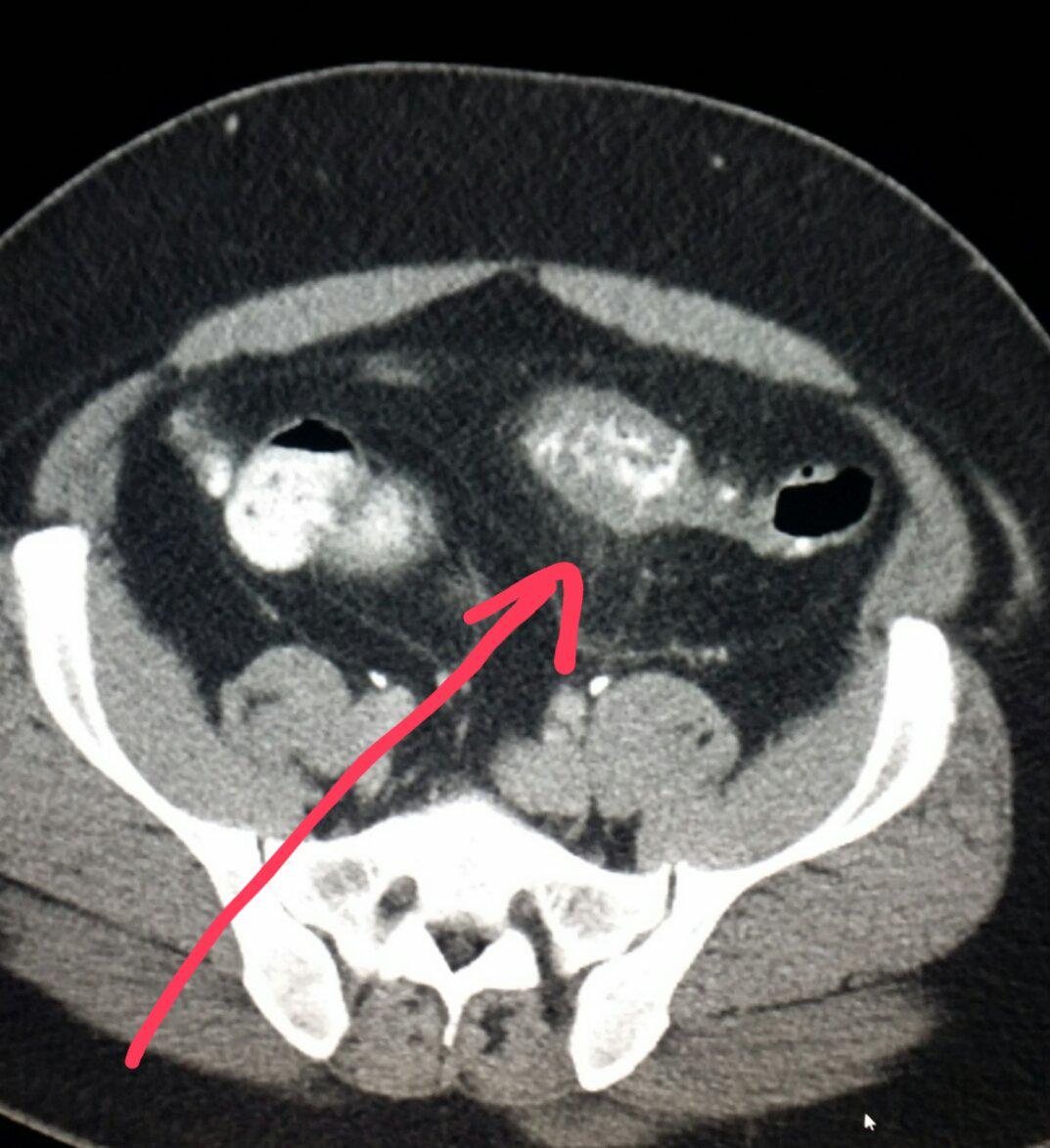 NBRadiologists's tweet photo. #Multidetector #CT of the #abdomen shows #inflammation of the #colon
(#diverticulitis) in #patient with #belly #pain http://t.co/IvWktLLxEU