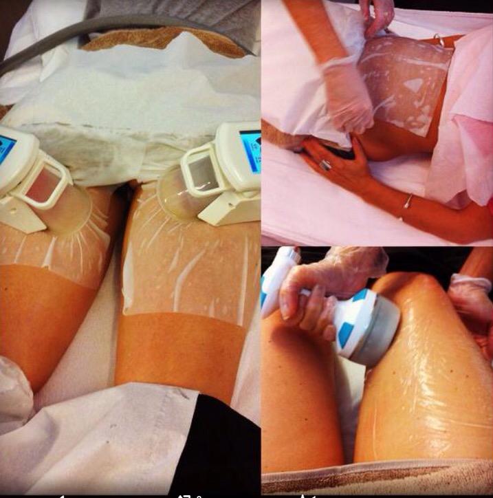 NicoleFrancisSP's tweet image. Troubles loosing weight! Become who u want to become! FATFREEZE £60 per area #Sale #fewslotsleft