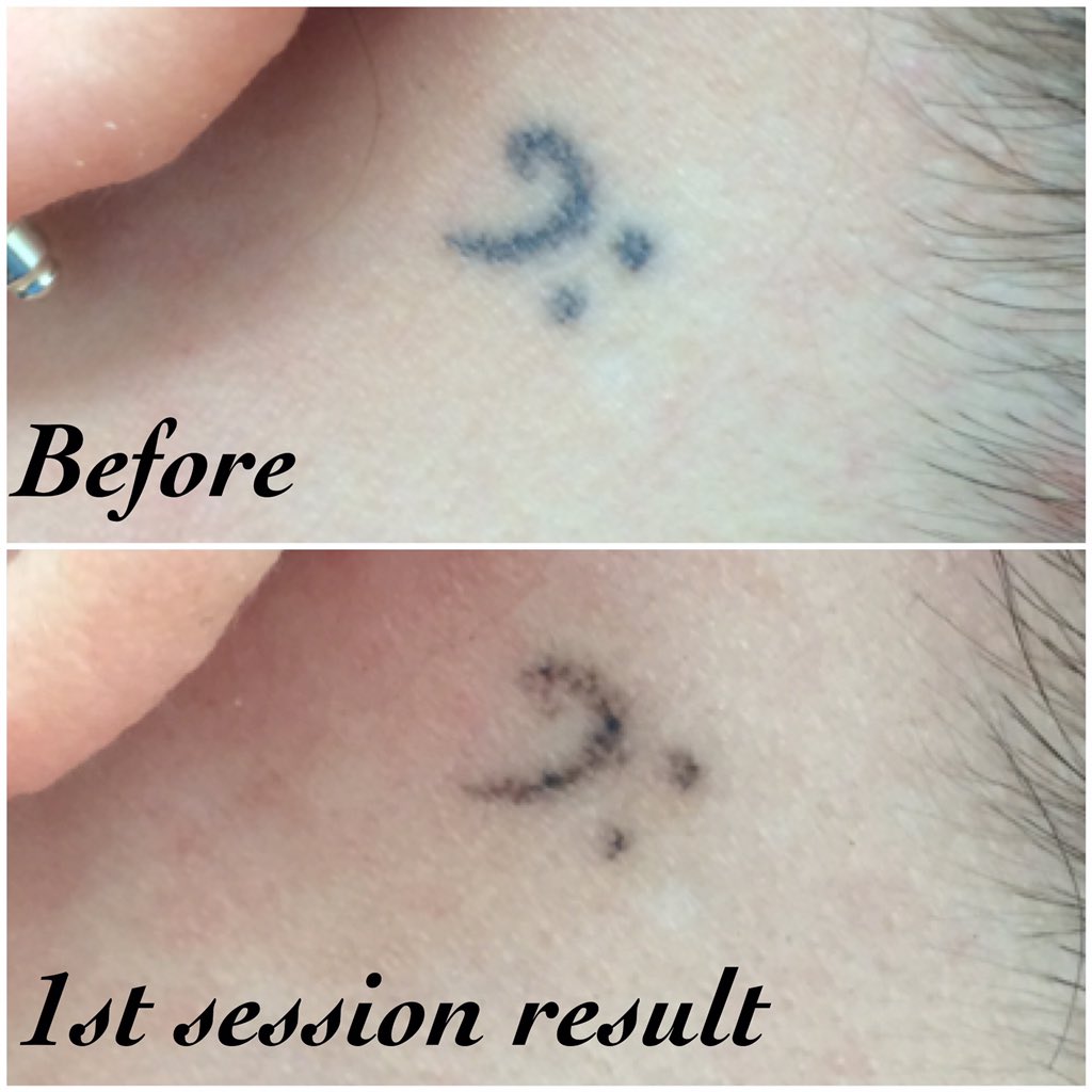 Laser Tattoo Removal at Rewind Laser Treatment  In Romford Essex