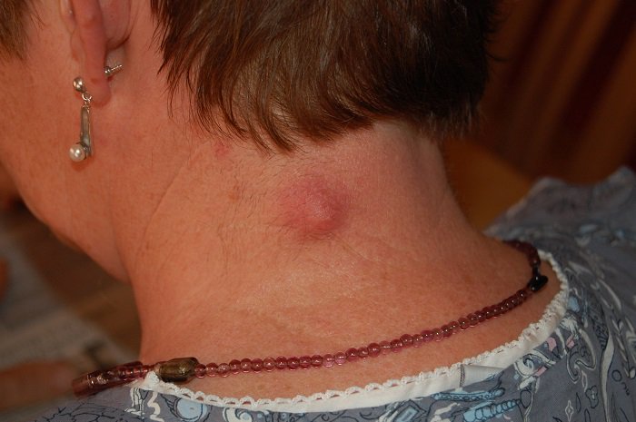 yhealthtips's tweet photo. does #sebaceouscyst put you in irritating situation. try this some best #homeremedies 
https://t.co/9Vhsn7RNkx https://t.co/cflaDFqFg0