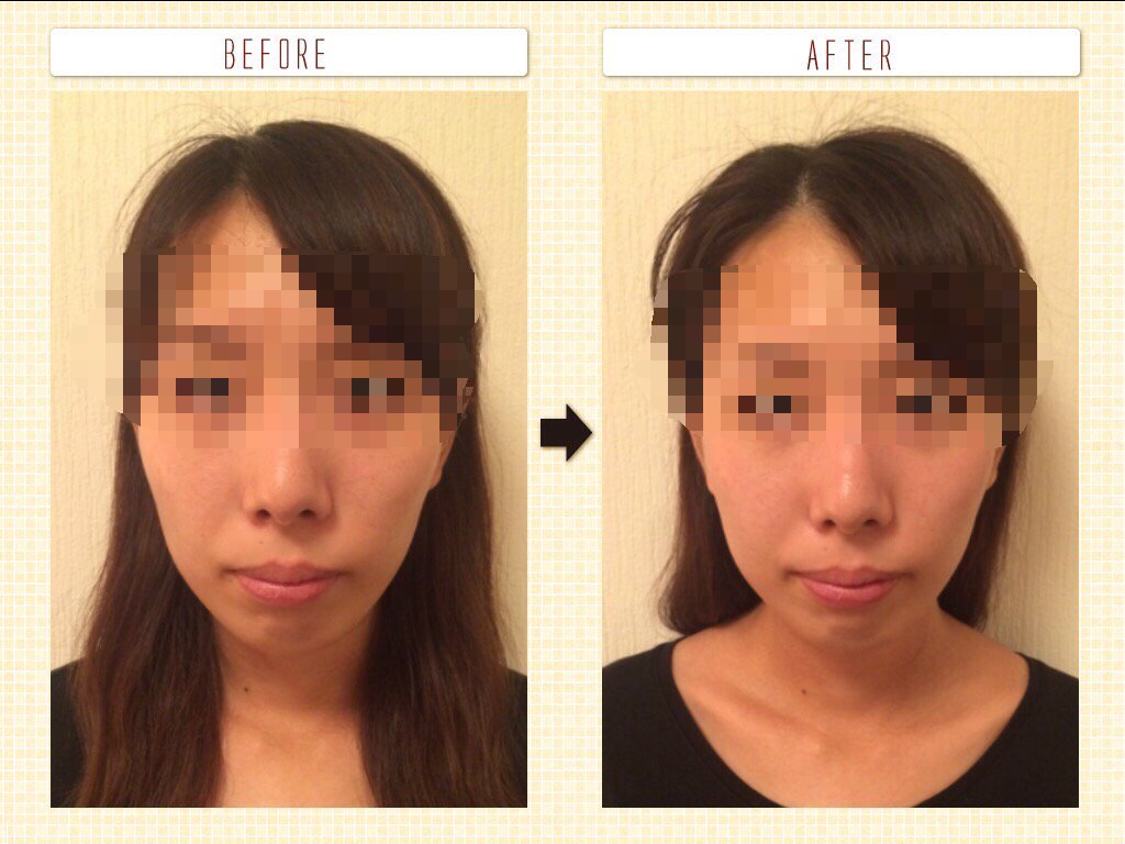 小顔科学研究所 面長を気にされていたhさん 初めての小顔矯正で少し不安ということでしたが カウンセリングで色々とお話させて頂き 安心して施術を受けて下さいました その結果 面長の長さが 0 4 印象も変わり喜んで頂けました 小顔科学研究所