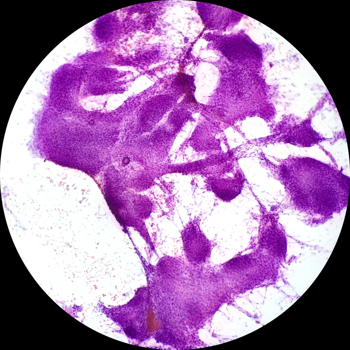 pathtutor_com's tweet image. ihcgame.com Meningioma smears and permanent sections @JMGardnerMD @JennyKHoang @pbaleixo @syntheslide